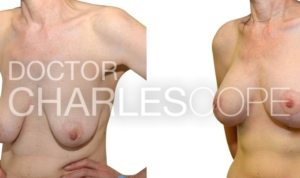 Breast augmentation with lift surgery, patient 51yo before and after 293-1