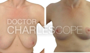 Breast reduction and lift at Dr Cope clinic, before and after photo 78