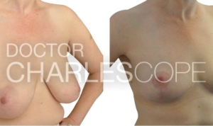 Breast reduction before & after, D cup to B cup, photo 78-1