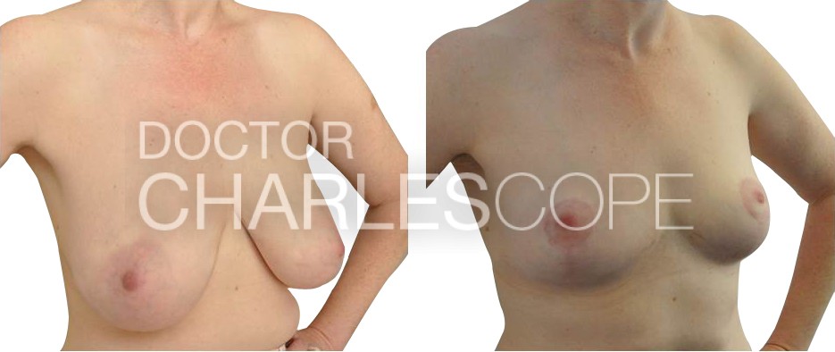 Breast Reduction Surgery Sydney & Gosford – 4