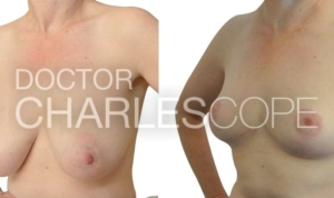 Breast reduction from D cup to B cup, before & after gallery 80